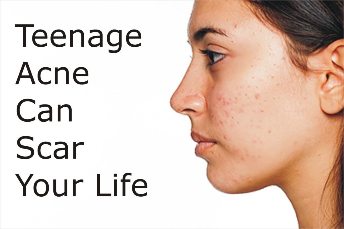 How to Get Rid of Teen Acne Dr. Health Clinic Homepage
