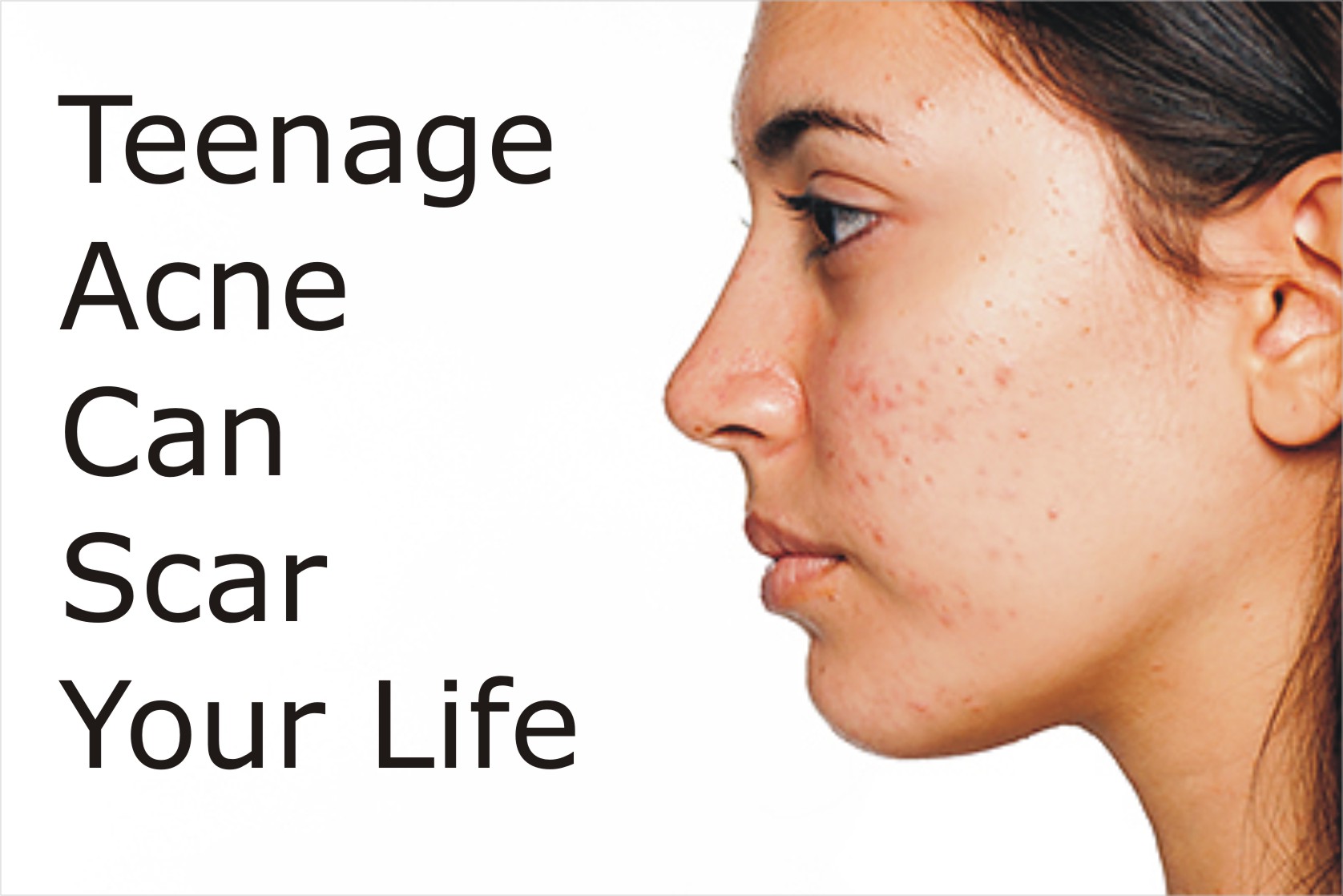 how to get rid of teen acne