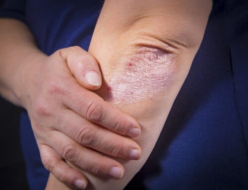 PSORIASIS FLARE UPS IN FLUCTUATING WEATHER