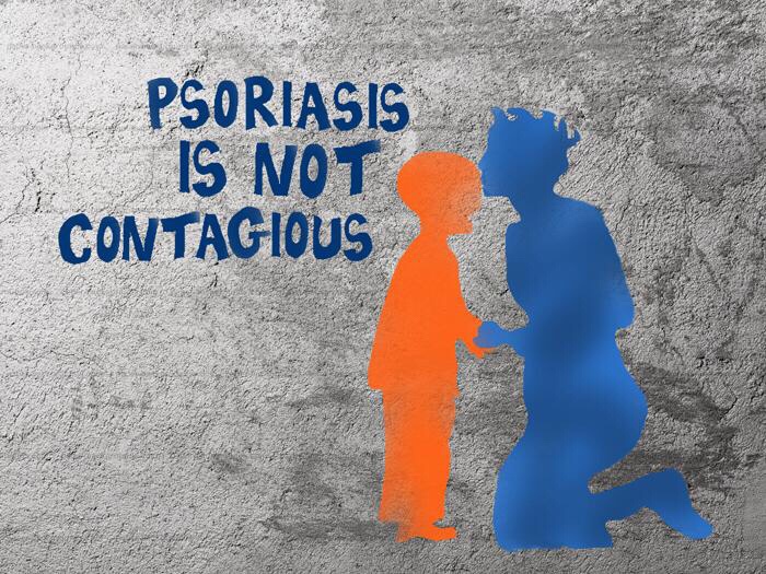 Psoriasis is Not Contagious > Dr. Health Clinic