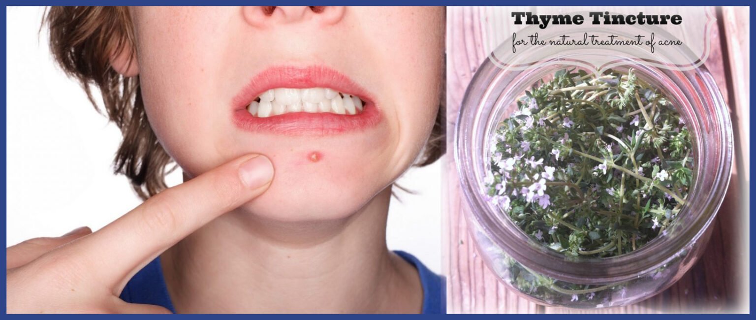 Beating Acne Is a Matter of “Thyme” Dr. Health Clinic Homepage