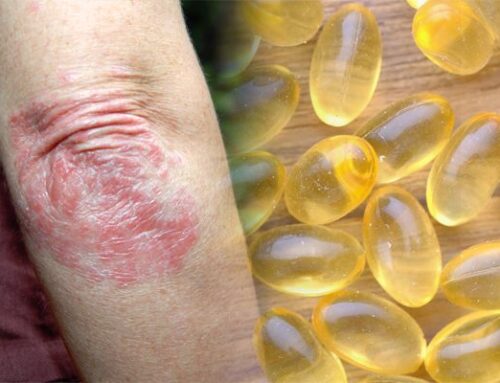 Omega-3 For Psoriasis