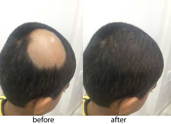 Alopecia Areata Know The Symptoms Causes And Treatment