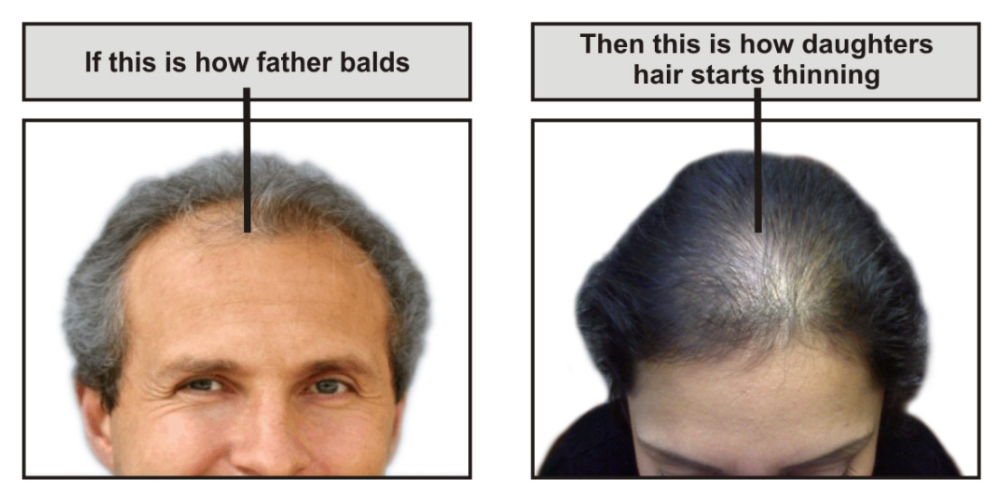 Solutions to Deal with Genetic Hair Loss Problem