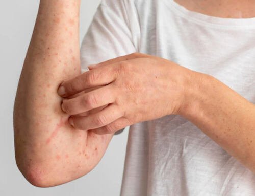 Eczema – Skin Allergy Treatment