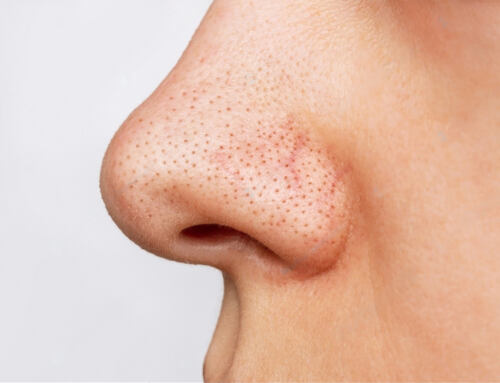Understanding Blackheads: What They Are and How They Form?