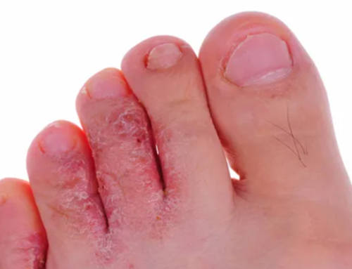 Understanding Athlete’s Foot: Types, Causes, and Effective Management