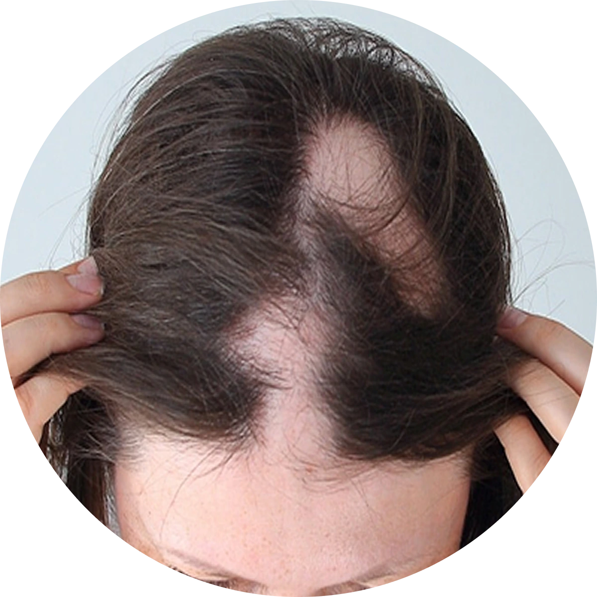 Alopecia Areata, Hypertrophic and keloid scars