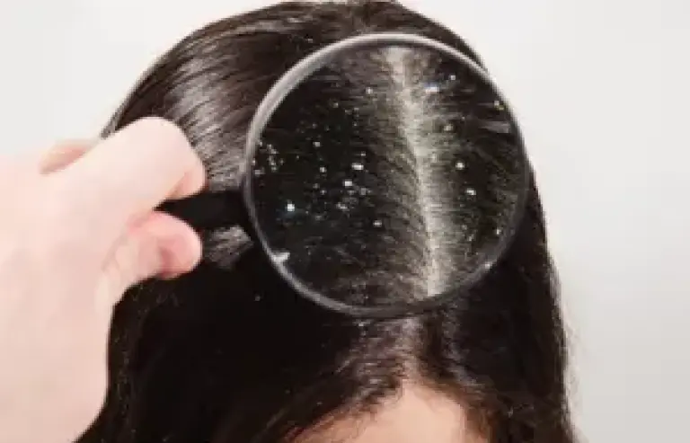 Dandruff Treatment