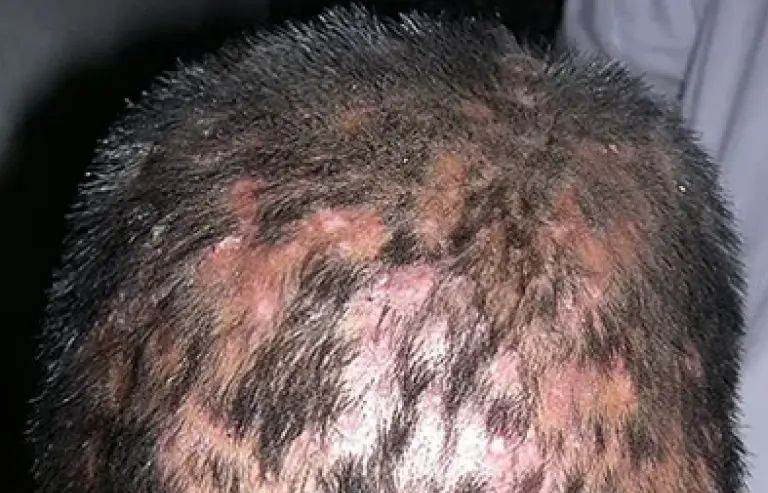  Alopecia Areata treatment
