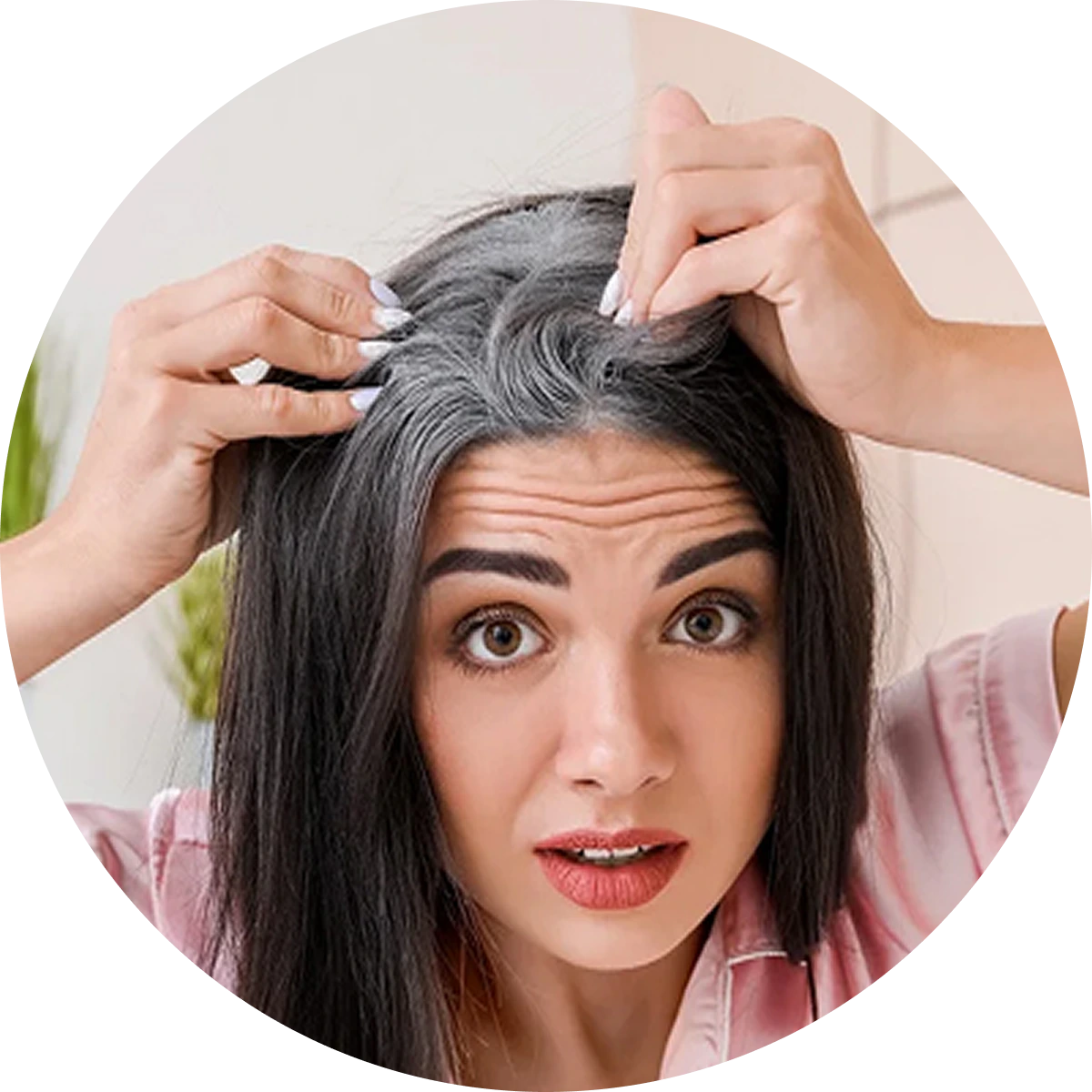 PREMATURE GRAY Hypertrophic and keloid scars