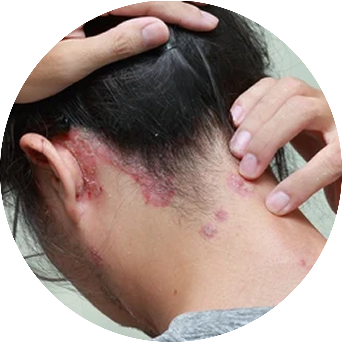 Scalp Infections Rolling Scars