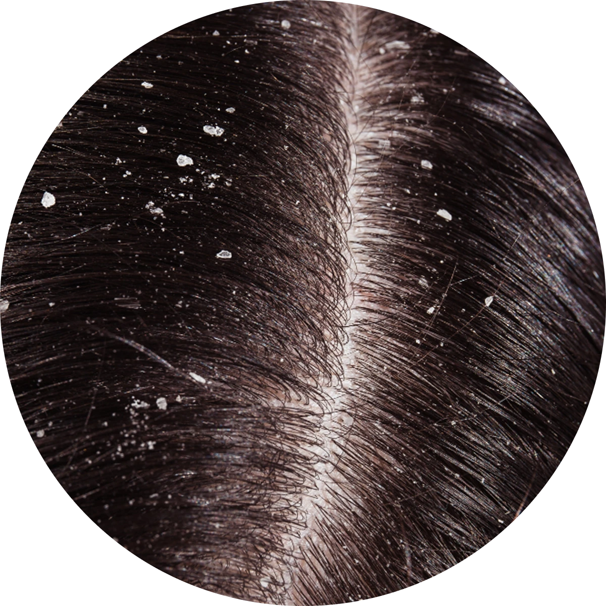 dandruff Boxcar Scars