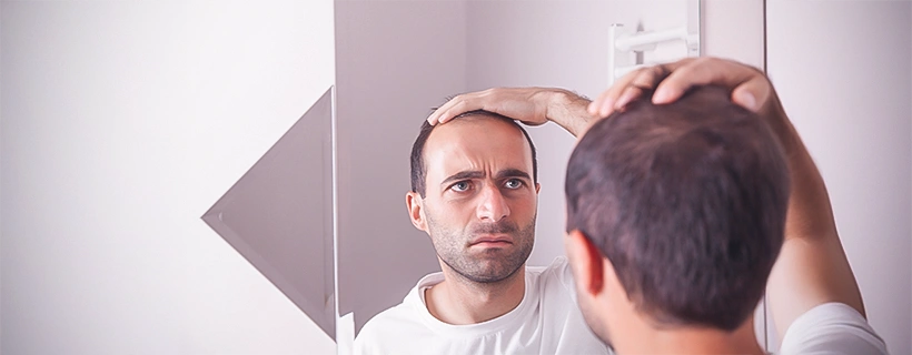 Alopecia (Mild) Also Known As