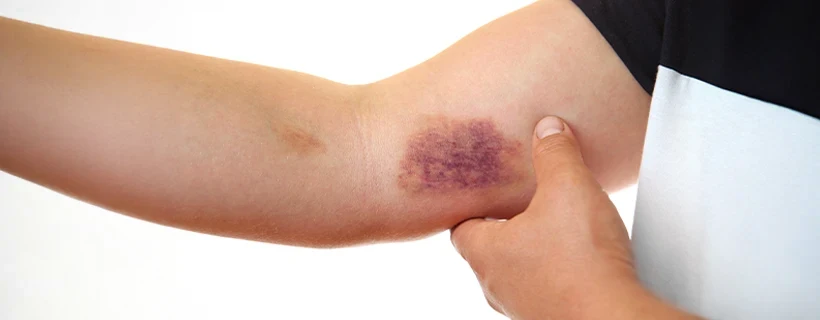 Acanthosis Nigricans Treatment