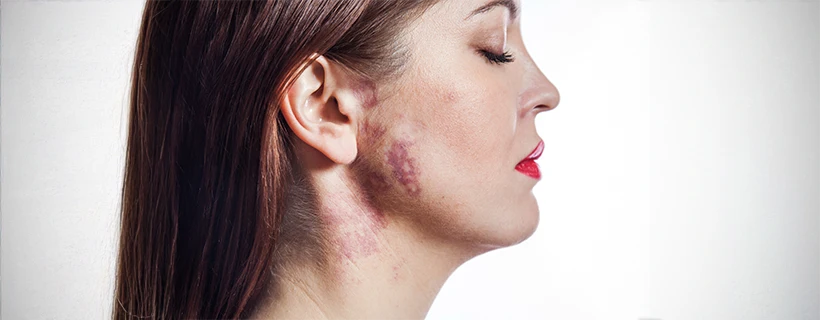 Acanthosis Nigricans Symptoms