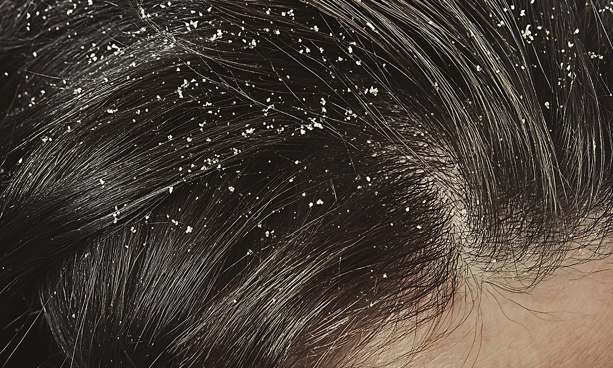 The bad dandruff