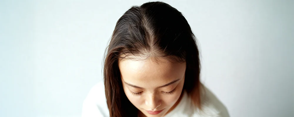 androgenetic-alopecia-female Also known as Also Known as