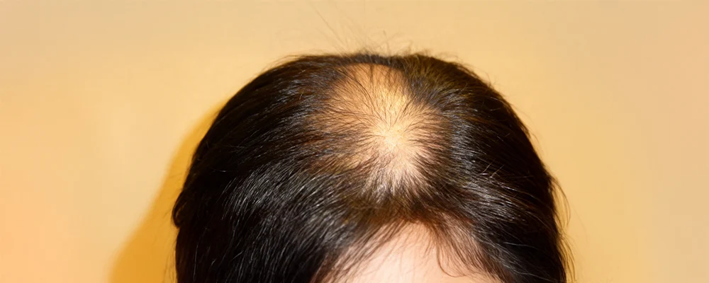 androgenetic-alopecia-female Common Symptoms Acne Vulgaris Causes