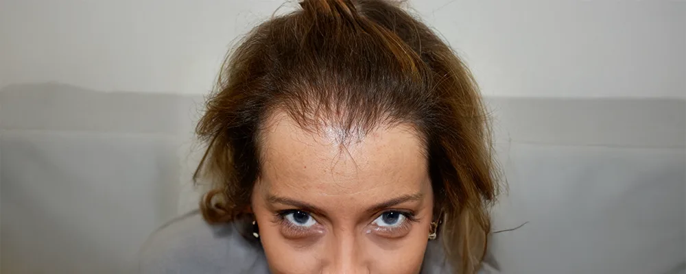 androgenetic-alopecia-female Who it effects Acne Vulgaris affects