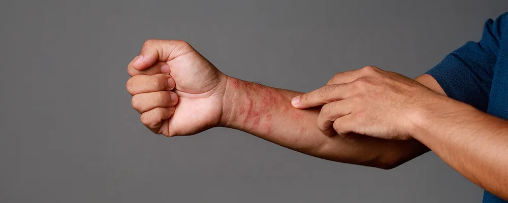 atopic-dermatitis Also Known as atopic-dermatitis Also Known as