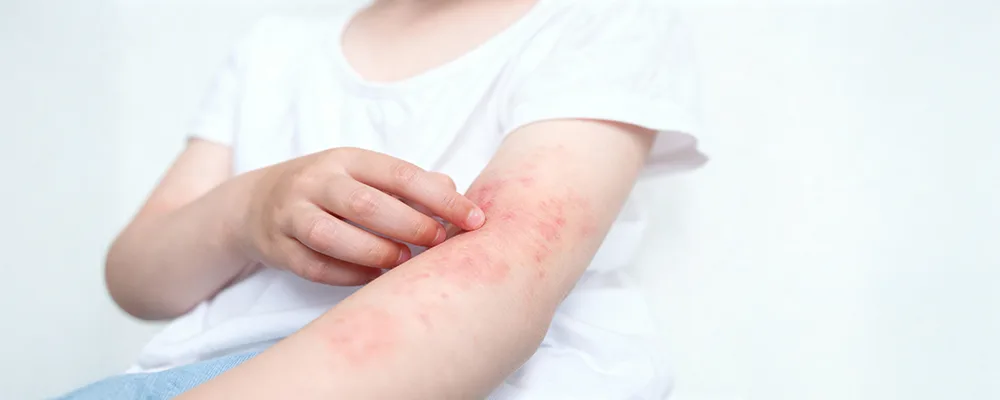 atopic-dermatitis Common Symptoms Acne Vulgaris Causes