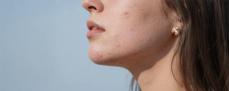 Acne scars – Common symptoms Acne Vulgaris affects