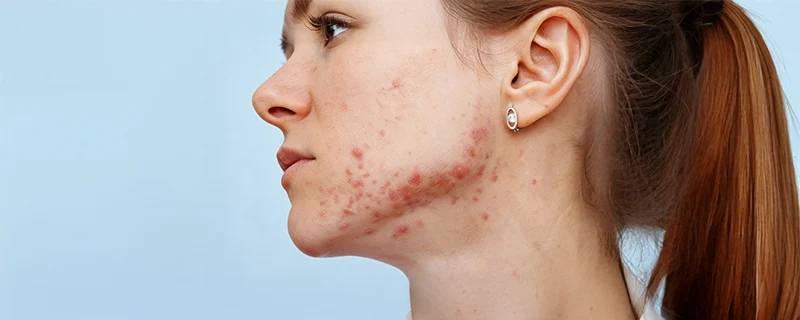 atopic-dermatitis Also Known as