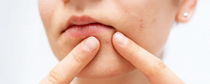 Acne Vulgaris Causes