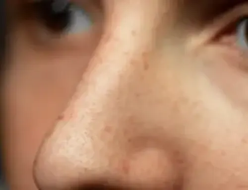 What Are Blackheads? Causes, Symptoms, and How to Prevent Them