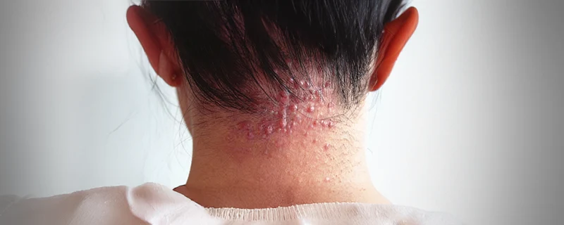 atopic-dermatitis Also Known as