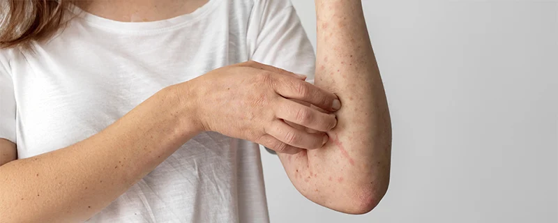 Allergic Contact Dermatitis Also Known As atopic-dermatitis Also Known as