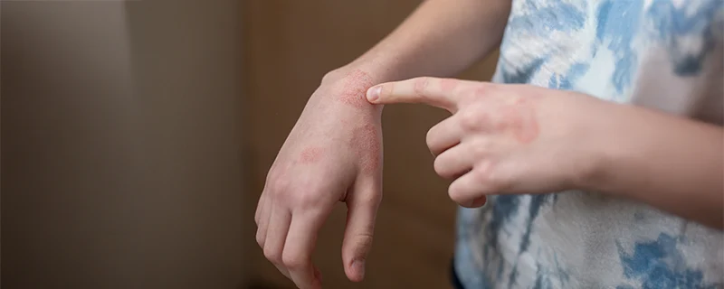 Allergic Contact Dermatitis Causes Acne Vulgaris Causes