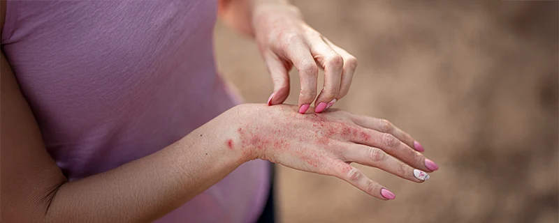 Allergic Contact Dermatitis Common Symptoms Acne Vulgaris affects