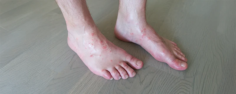 atopic-dermatitis Also Known as