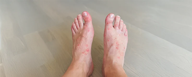 Acne Vulgaris Causes