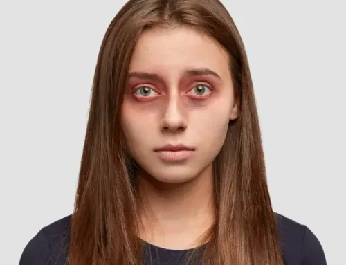 Home Remedies for Dark Circles