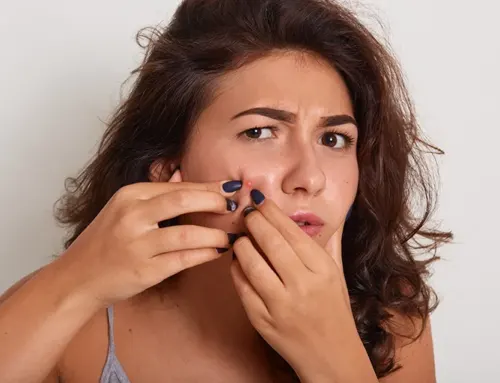 10 Effective Home Remedies for Pimples