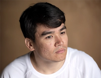 Acne scars treatment