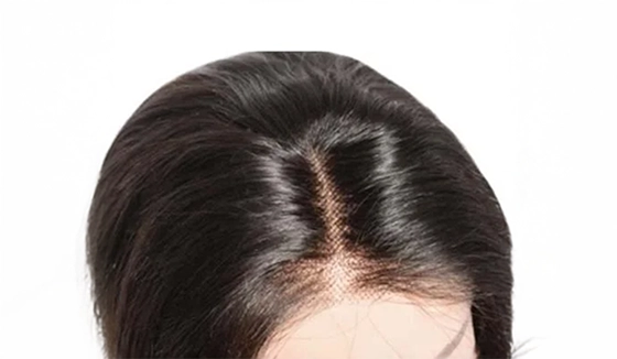 Dandruff After