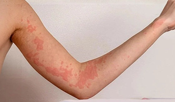 Urticaria Before