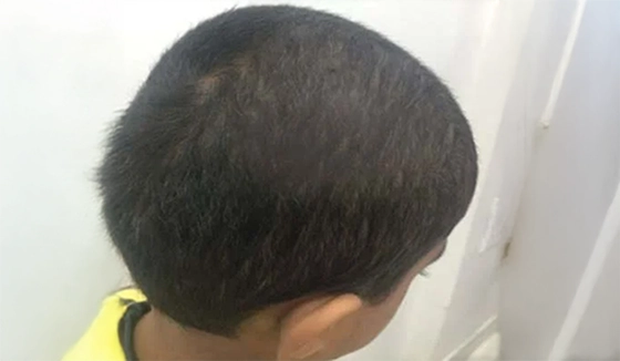 alopecia After