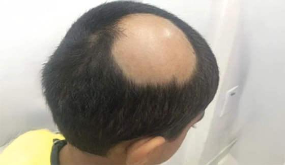 alopecia Before 1