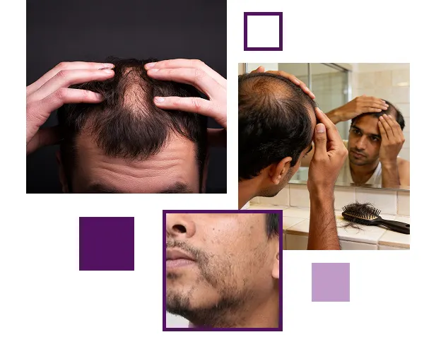 A Complete Guide to Patchy Hair
