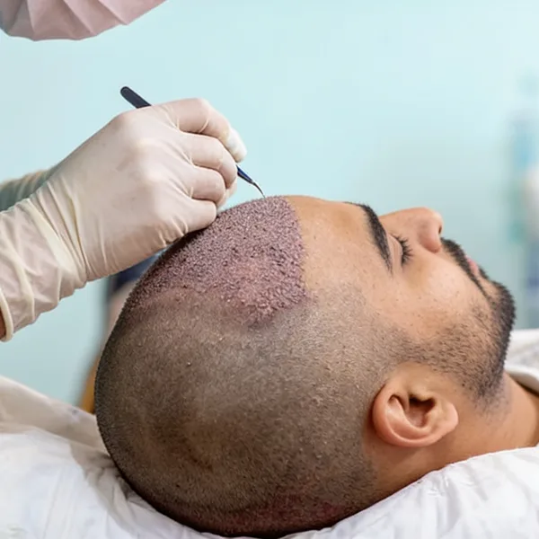 The Truth About Hair Transplant Limitations The Truth About Hair Transplant Limitations