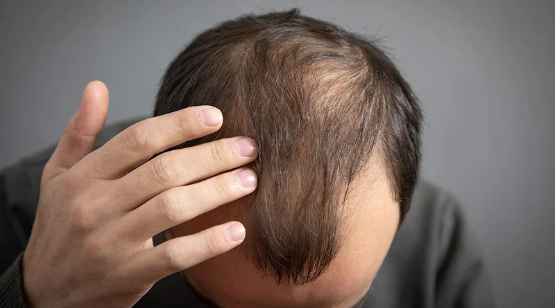 What is Pattern Hair loss in men What is Pattern Hair loss in men