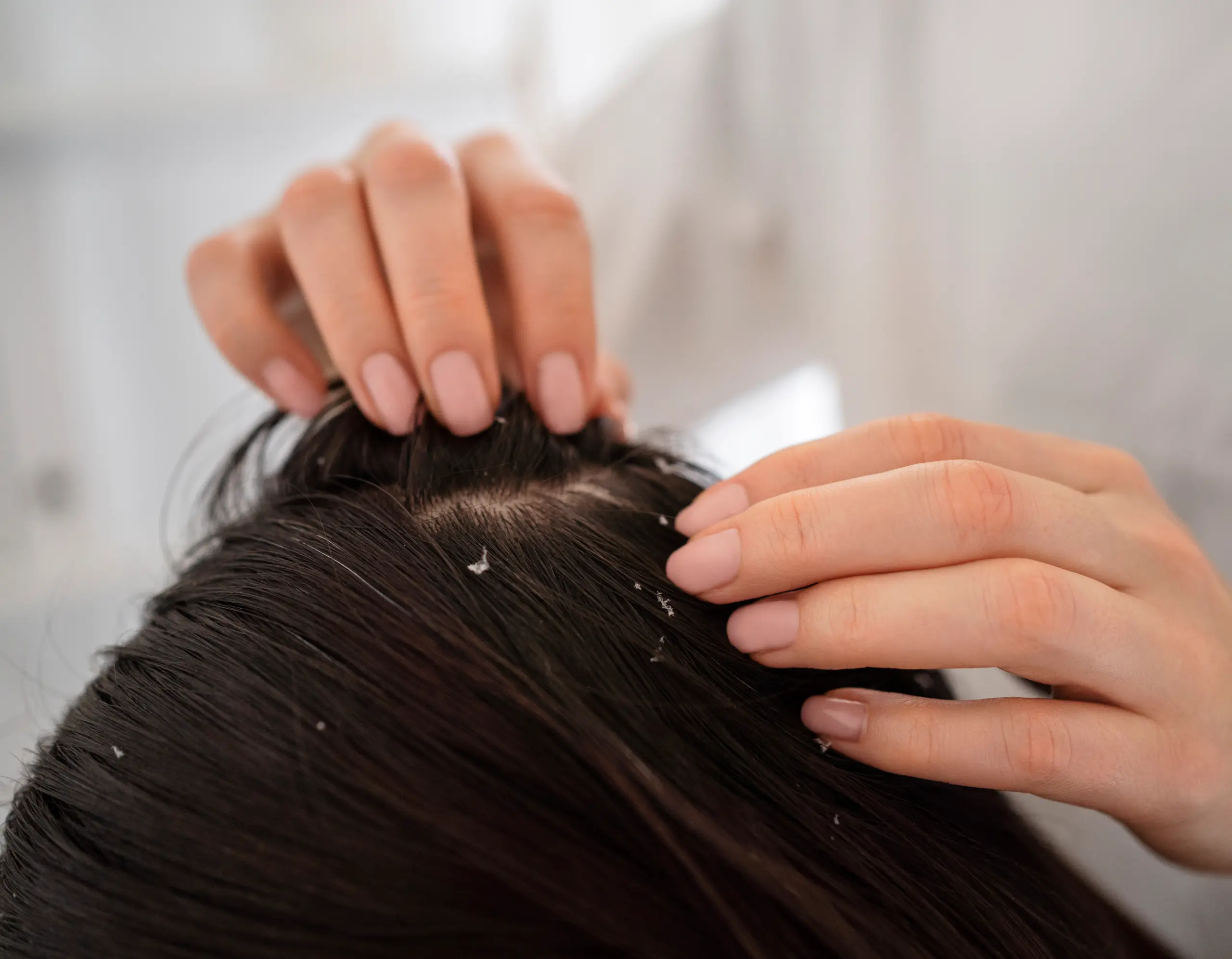 long term Hormonal Acne