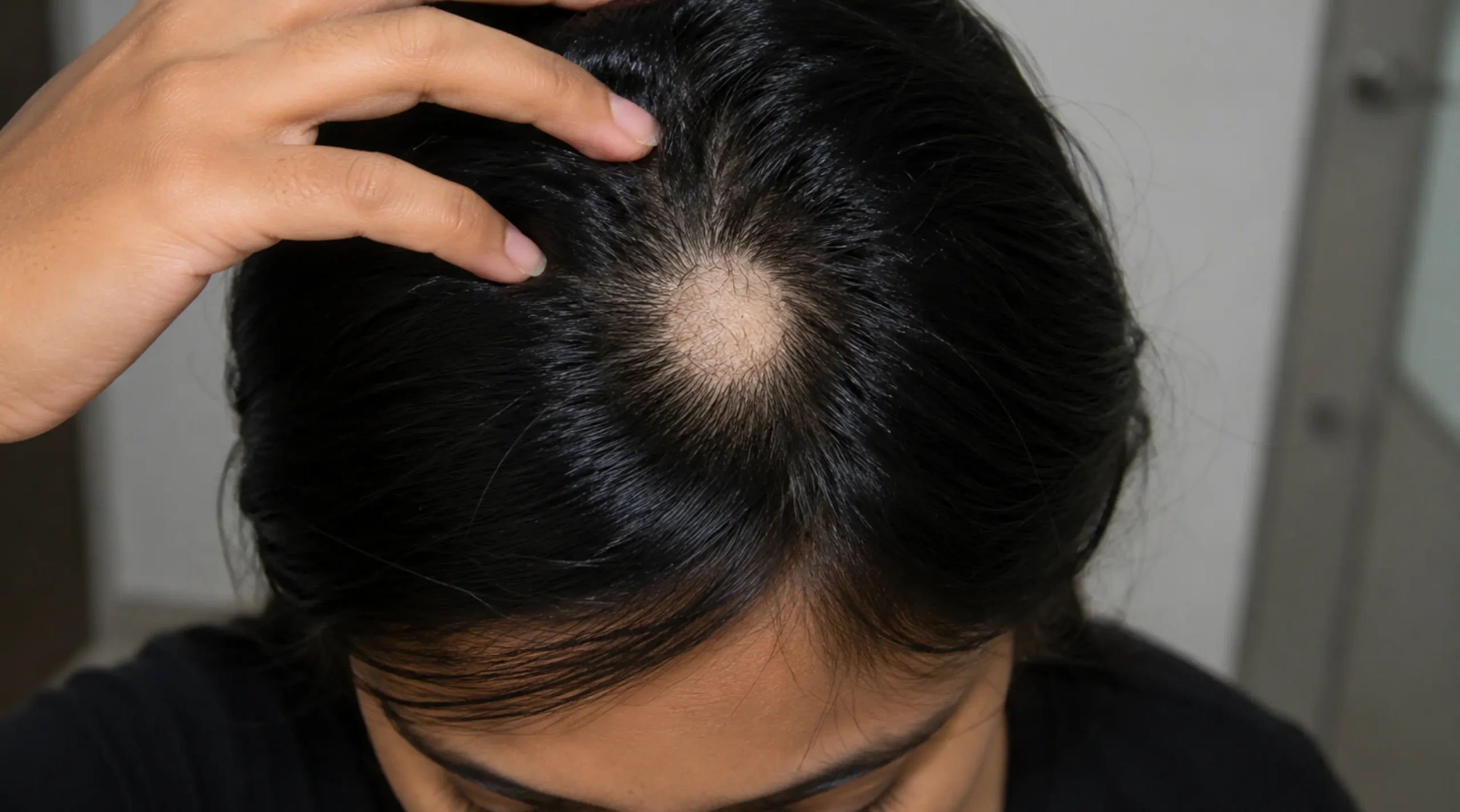 Alopecia Areata Increase confident