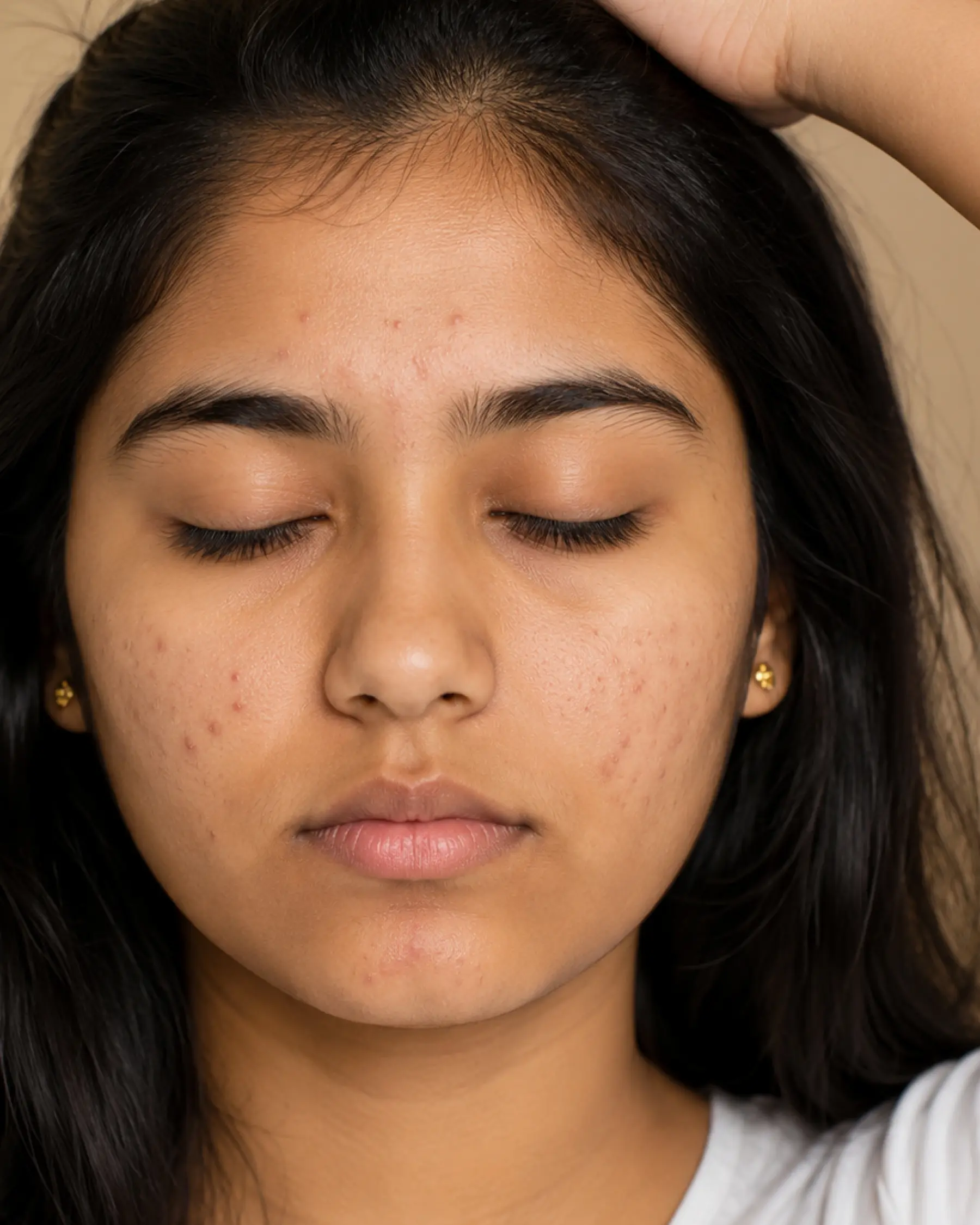 Why Dr. Health Offers the Best Acne Treatment in Bangalore