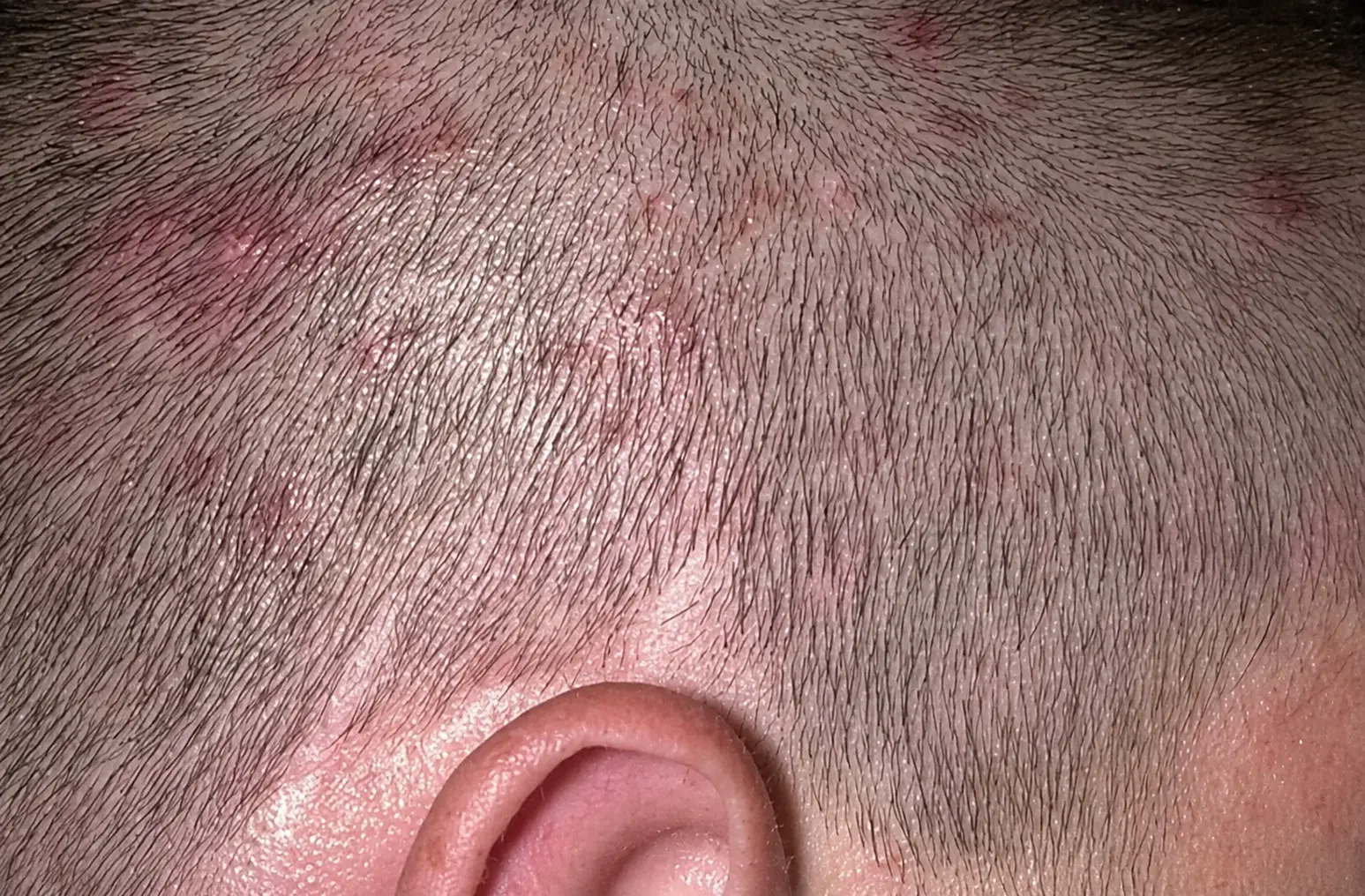 bacteria Acne Covers Large Areas